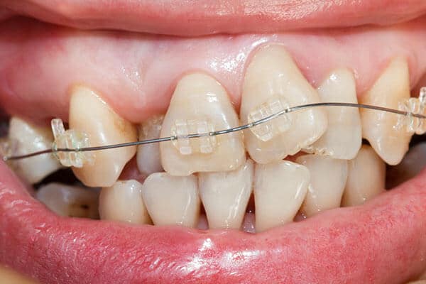 Braces to correct excessive crowding